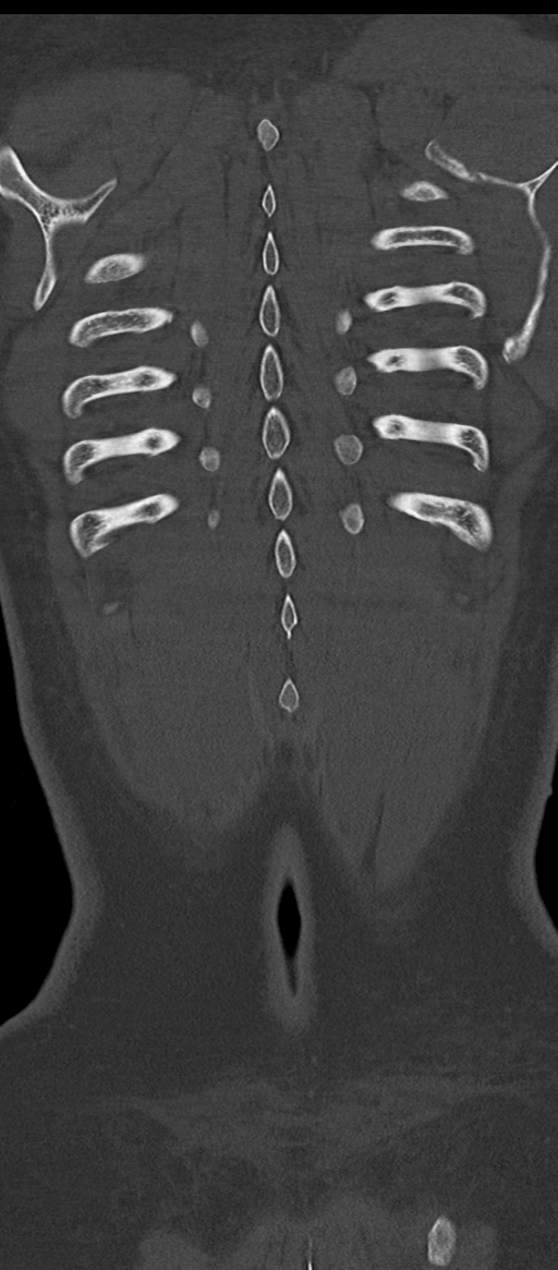 Normal thoracolumbar spine (Radiopaedia 43822-47309 Coronal bone window 83).png