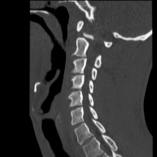 File:Normal trauma cervical spine (Radiopaedia 41017-43760 Sagittal bone window 16).png