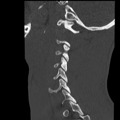File:Normal trauma cervical spine (Radiopaedia 41017-43760 Sagittal bone window 38).png
