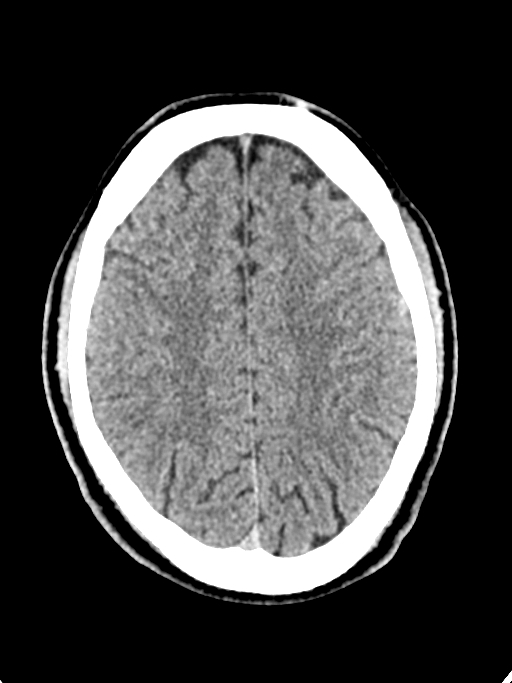 Normal trauma protocol brain and C-spine CT (Radiopaedia 83302-97709 Axial non-contrast 25).jpg