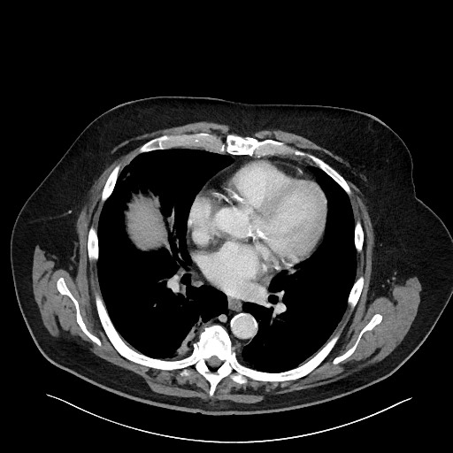 Obstructing sigmoid adenocarcinoma (Radiopaedia 58465-65619 A 6).jpg
