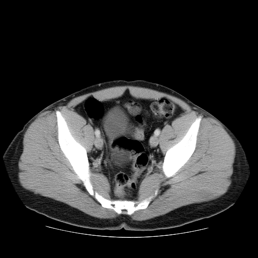 File:Obstructing ureteric calculus (Radiopaedia 18615-18514 B 47).jpg