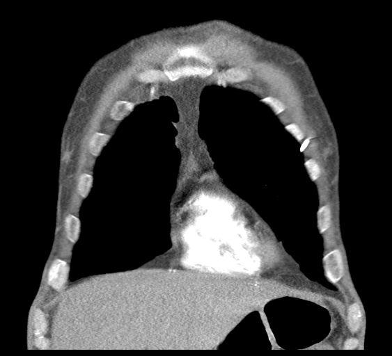 File:Obstructive superior vena cava tumor thrombus (Radiopaedia 28046-28306 B 11).jpg