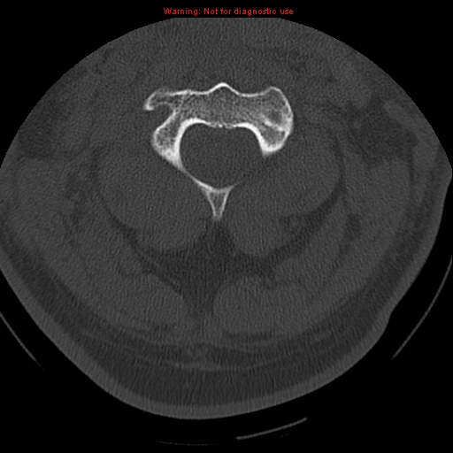 File:Occipital condyle fracture (Radiopaedia 18366-18208 Axial bone window 25).jpg