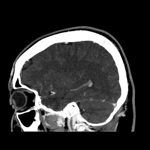 Occipital extradural hematoma simulating venous sinus thrombosis (Radiopaedia 46514-50964 D 24).jpg