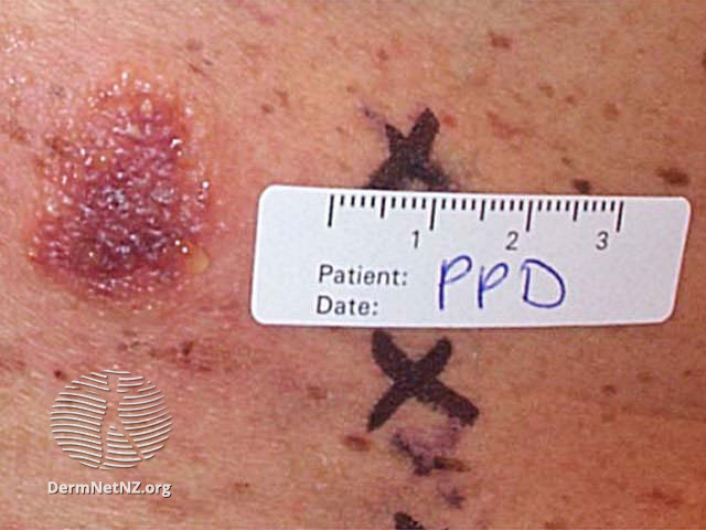 File:Positive patch test (DermNet NZ dermatitis-pt-ppd).jpg
