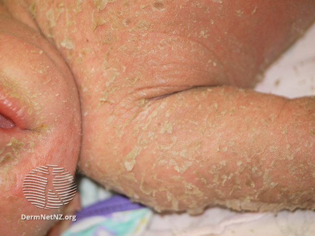 File:Staphylococcal scalded skin syndrome (DermNet NZ ssss-036).jpg