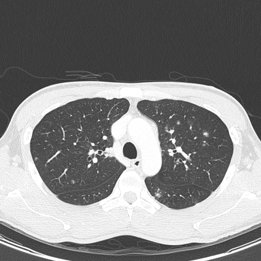 AIDS-related Kaposi sarcoma (Radiopaedia 85247-100811 Axial lung window 50).jpg