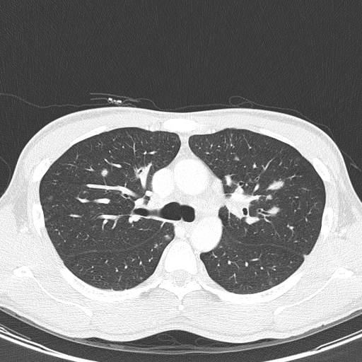 AIDS-related Kaposi sarcoma (Radiopaedia 85247-100811 Axial lung window 57).jpg