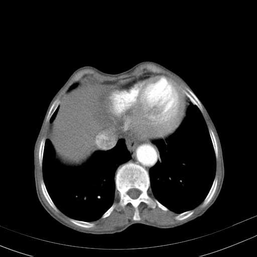 File:Abdominal aortic aneurysm (Radiopaedia 20827-20742 Axial C+ arterial phase 3).jpg