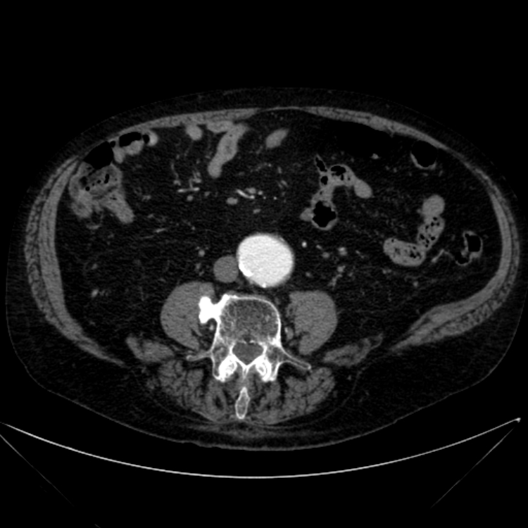 Abdominal aortic aneurysm (Radiopaedia 25855-26001 Axial C+ arterial phase 80).jpg