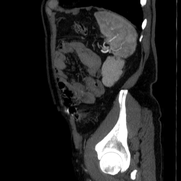 Abdominal aortic aneurysm (Radiopaedia 29248-29660 Sagittal C+ arterial phase 45).jpg