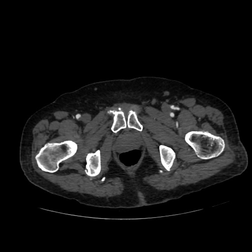 File:Abdominal aortic aneurysm (Radiopaedia 57318-64259 Axial C+ arterial phase 78).jpg