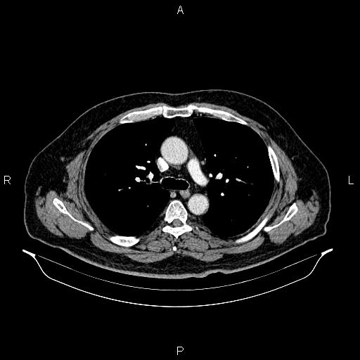 Abdominal aortic aneurysm (Radiopaedia 83094-97462 Axial renal cortical phase 31).jpg
