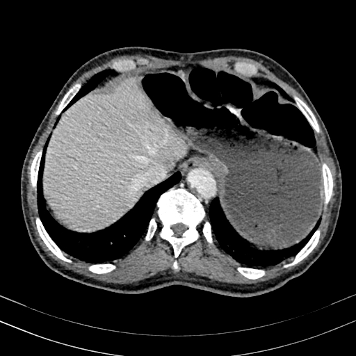 File:Abdominal aortic aneurysm (Radiopaedia 83581-98689 Axial C+ portal venous phase 16).jpg