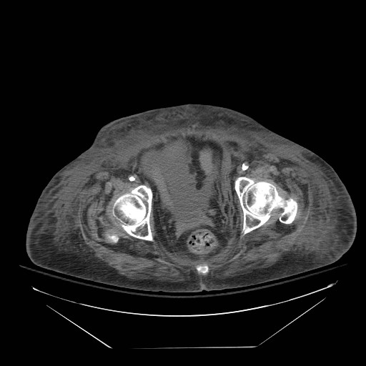 Abdominal aortic aneurysm - impending rupture (Radiopaedia 19233-19247 Axial non-contrast 153).jpg