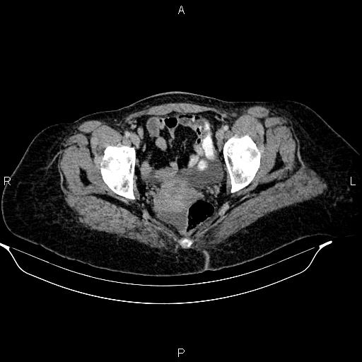 Abdominal lymphoma with sandwich sign (Radiopaedia 84378-99704 Axial C+ portal venous phase 53).jpg