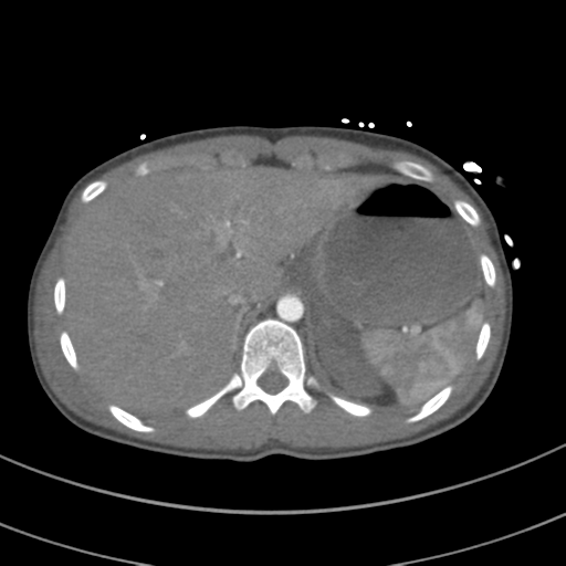 File:Abdominal multi-trauma - devascularised kidney and liver, spleen and pancreatic lacerations (Radiopaedia 34984-36486 Axial C+ arterial phase 82).png