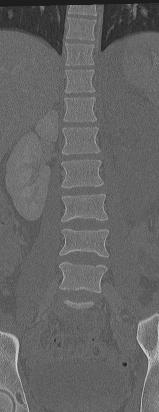 Abdominal multi-trauma - devascularised kidney and liver, spleen and pancreatic lacerations (Radiopaedia 34984-36486 Coronal bone window 25).png
