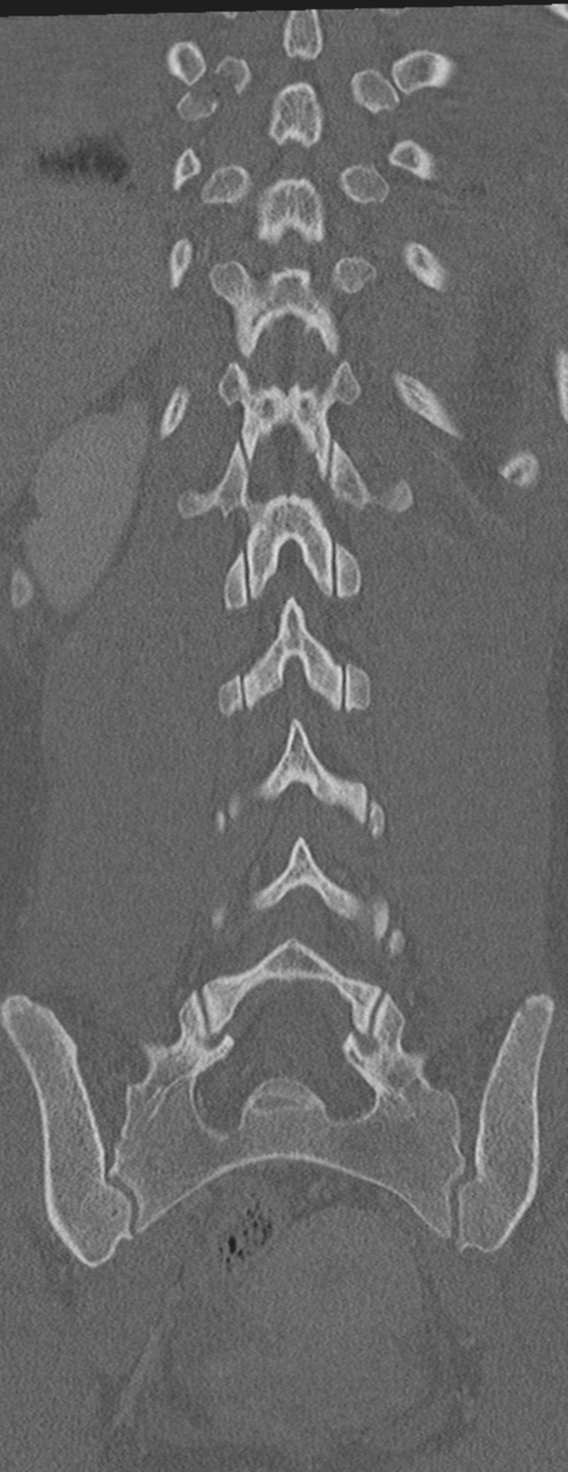 Abdominal multi-trauma - devascularised kidney and liver, spleen and pancreatic lacerations (Radiopaedia 34984-36486 Coronal bone window 50).png