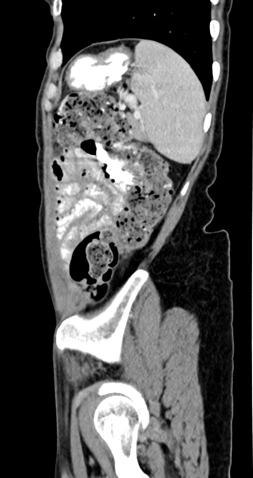 Abdominal wall and retroperitoneal tuberculosis (Radiopaedia 88137-104729 Sagittal C+ portal venous phase 32).jpg
