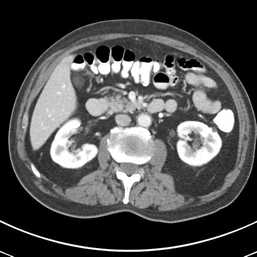 Abdominal wall metastasis from colorectal carcinoma (Radiopaedia 31016-31717 Axial C+ portal venous phase 32).jpg