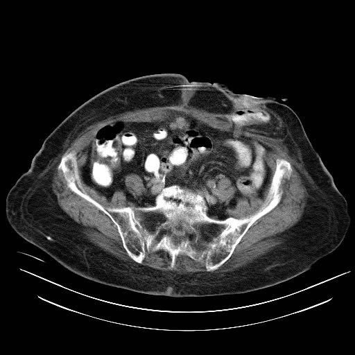 File:Abdominal wall recurrence after colorectal resection for cancer (Radiopaedia 23444-23523 Axial C+ portal venous phase 27).jpg