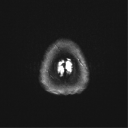 File:Abducens nerve palsy (Radiopaedia 51069-56648 Axial DWI 27).png