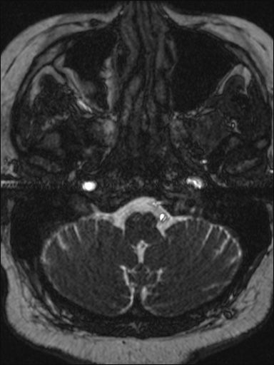 File:Abducens nerve palsy (Radiopaedia 57084-63976 Axial T2 ciss 3d 8).jpg