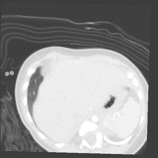 File:Aberrant left pulmonary artery (pulmonary sling) (Radiopaedia 42323-45435 Axial lung window 38).jpg