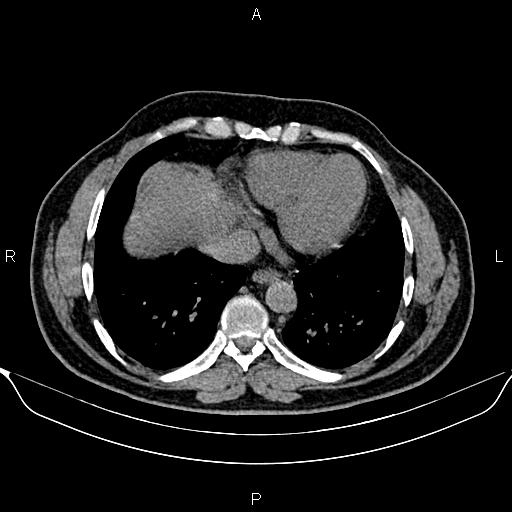 Aberrant right subclavian artery (Radiopaedia 87093-103354 Axial non-contrast 80).jpg