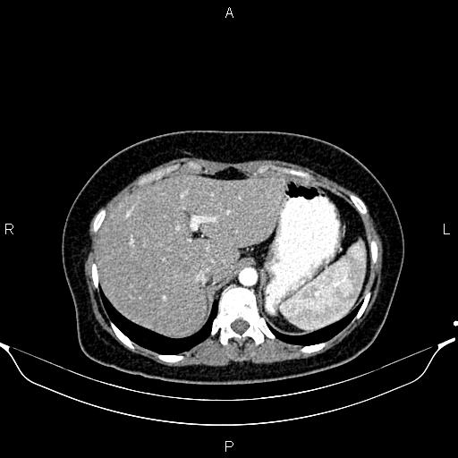 Aberrant right subclavian artery (Radiopaedia 87334-103629 Axial C+ arterial phase 62).jpg