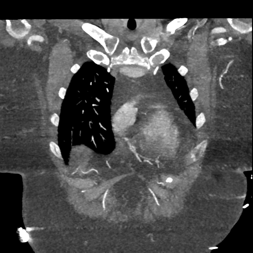 File:Aberrant right subclavian artery with Kommerell diverticulum (Radiopaedia 47982-52769 Coronal C+ arterial phase 15).png