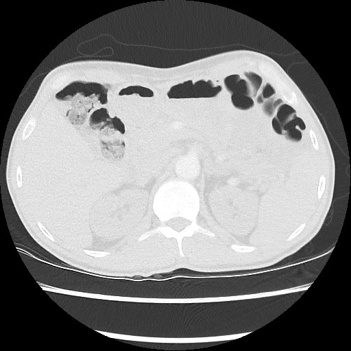 Accessory left horizontal fissure with lingular pneumonia (Radiopaedia 53763-59843 Axial lung window 58).jpg