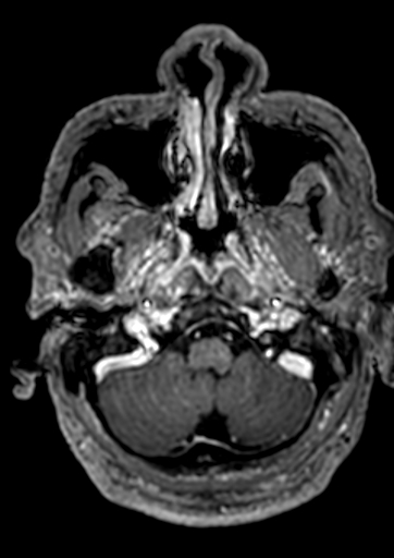 Accessory middle cerebral artery (Radiopaedia 73114-83828 Axial T1 C+ 166).jpg