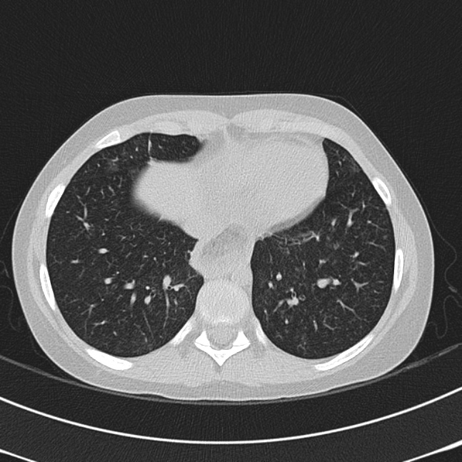 Achalasia (Radiopaedia 14946-14878 Axial lung window 59).jpg