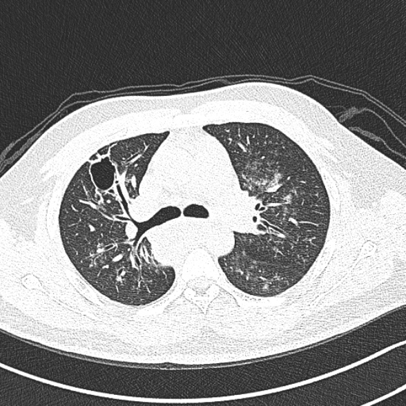 File:Achalasia with aspiration (Radiopaedia 55413-61845 Axial lung window 26).jpg