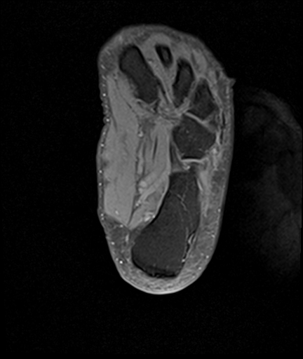 File:Achilles tendon tear (Radiopaedia 77615-89819 Axial PD fat sat 26).jpg