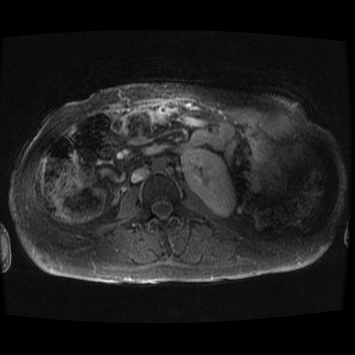 Acinar cell carcinoma of the pancreas (Radiopaedia 75442-86668 Axial late phase (~30 mins) 9).jpg