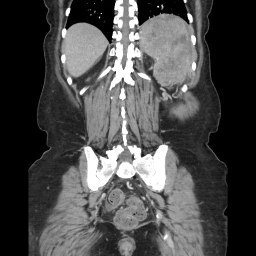 Acinar cell carcinoma of the pancreas (Radiopaedia 75442-86669 Coronal C+ portal venous phase 100).jpg