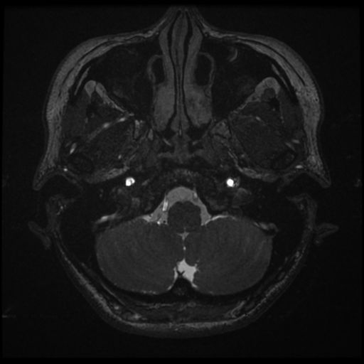 Acoustic neuroma (Radiopaedia 34049-35283 Axial 13).png