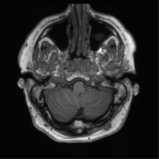 File:Acoustic schwannoma (Radiopaedia 50846-56358 Axial T1 4).png
