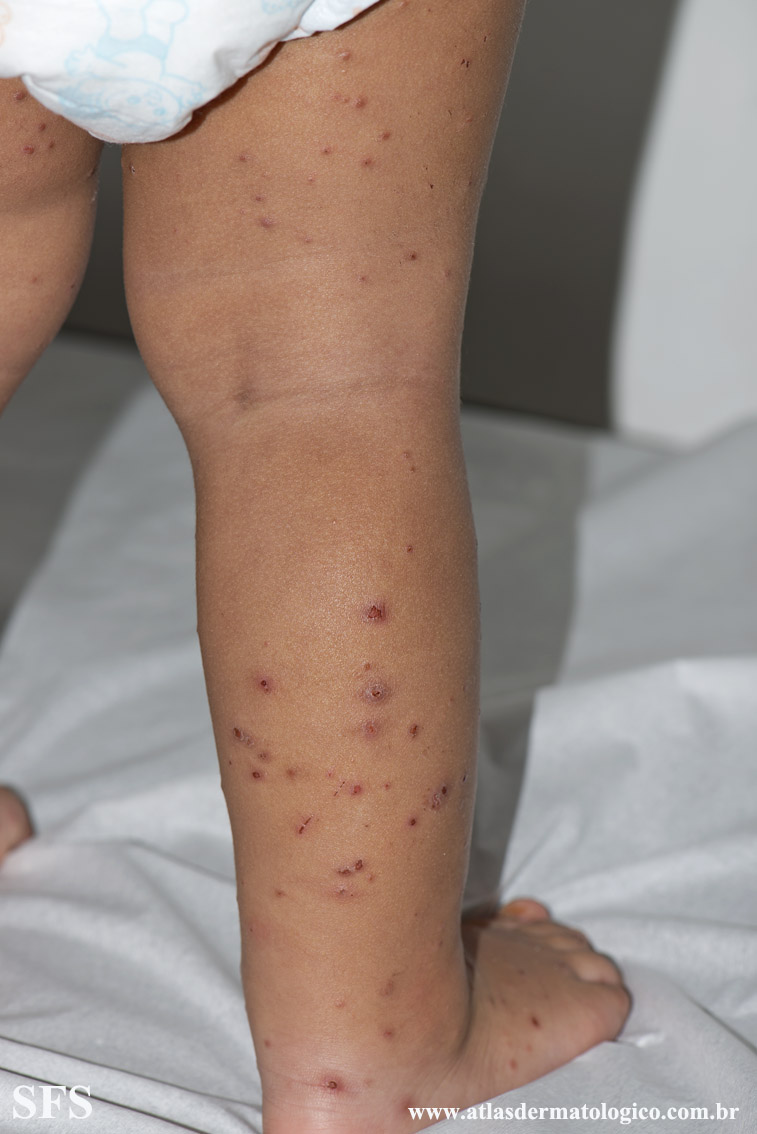Acrodermatitis Infantile Papular (Dermatology Atlas 21).jpg