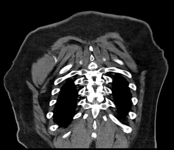 Acromioclavicular joint cyst (Radiopaedia 58455-65610 Coronal C+ arterial phase 125).jpg