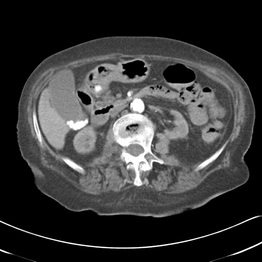 File:Active bleeding from duodenal ulcer with embolization (Radiopaedia 34216-35481 Axial C+ arterial phase 25).png