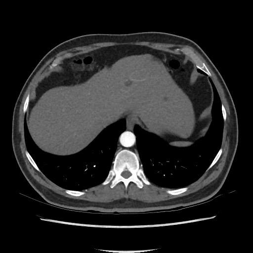 File:Active colonic bleed on CT (Radiopaedia 49765-55025 Axial C+ arterial phase 13).jpg