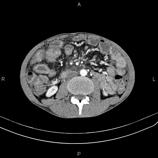 Active crohn disease (Radiopaedia 87133-103397 Axial C+ arterial phase 55).jpg