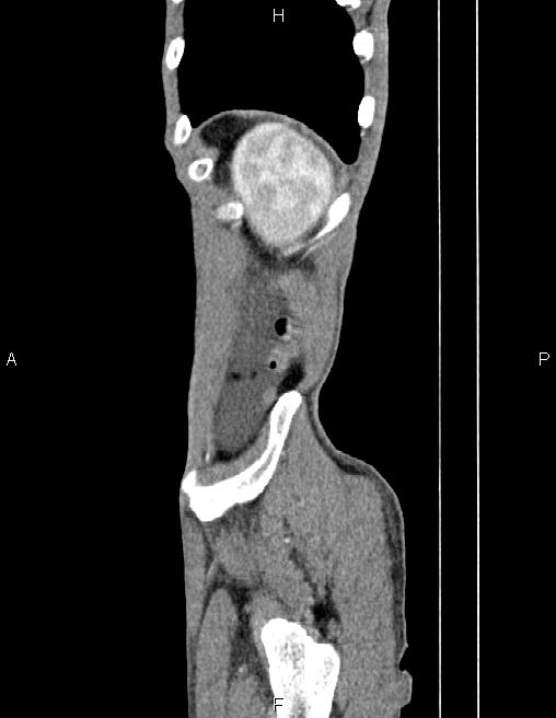 Active crohn disease (Radiopaedia 87133-103397 Sagittal C+ arterial phase 83).jpg