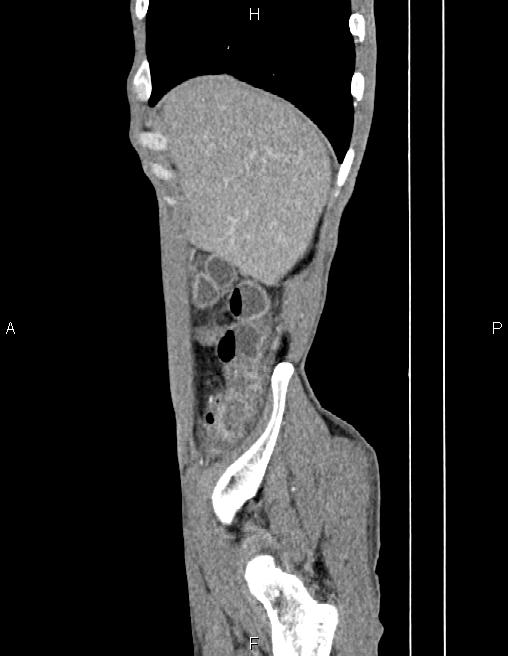 Active crohn disease (Radiopaedia 87133-103397 Sagittal C+ arterial phase 9).jpg