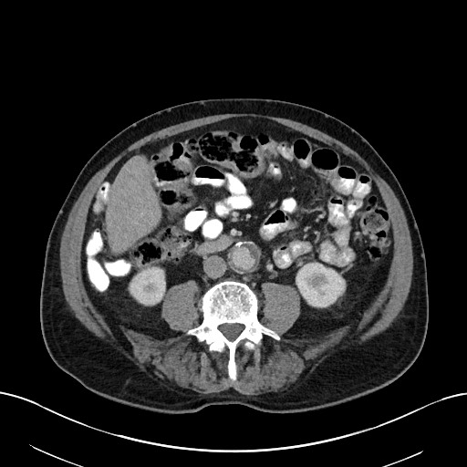 File:Active lower gastrointestinal bleeding - diverticular (Radiopaedia 61203-69106 Axial C+ portal venous phase 70).jpg